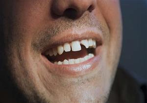 ما الحل الأمثل لعلاج "الأسنان المكسورة"؟.. (فيديو)