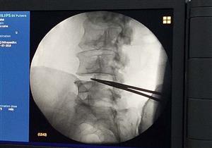 "تبخير الغضروف".. وسيلة علاجية لـ"الانزلاق" لا تستغرق نصف ساعة