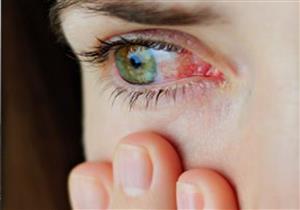 ما الفرق بين التهاب العين والحساسية؟ - استشاري يوضح