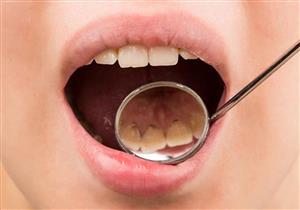  كيف نفرق بين طبقة البلاك وتسوس الأسنان وأيهما أخطر؟