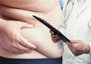 خسارة الوزن ضرورية لمرضى فيروس سي.. متى نلجأ للجراحة؟