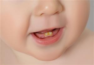 أسنان الرضيع عُرضة للتسوس.. كيف تحميها؟