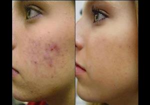 10 نصائح للتخلص من حب الشباب بشكل نهائي