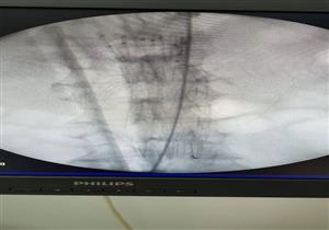 بالصور.. فريق طبي بجامعة المنصورة يجري أول حالة تمدد لشريان أورطي بالقسطرة التداخلية