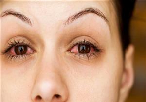 تعاني من "العيون الدامية"؟.. إليك الأسباب والأعراض وروشتة العلاج