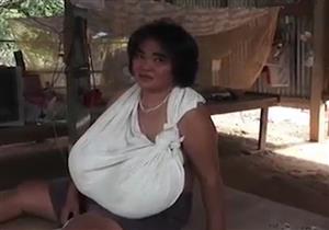 أدى لتضخم الثدي.. مرض نادر يحرم امرأة من المشي بصورة طبيعية