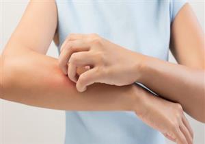 لدغات الحشرات.. متى تستلزم استشارة الطبيب؟ 