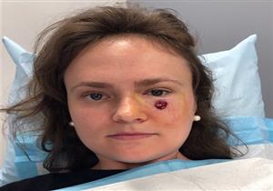 "حباية" أسفل العين تكشف إصابة فتاة بسرطان جلد