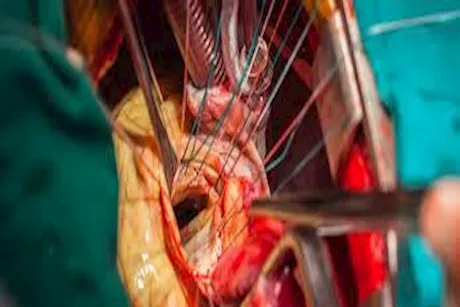 بعد جراحة القلب المفتوح- إليك الممنوعات