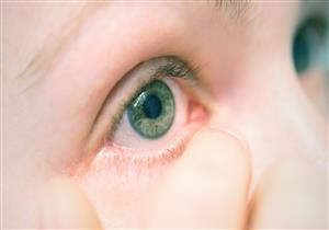 التهاب الشبكية الصباغي يهدد الأطفال بالعمى.. إليك طرق علاجه