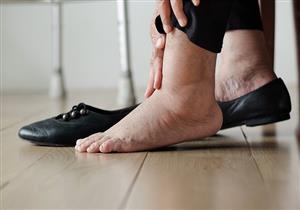 5 أطعمة تخلصك من احتباس السوائل بالجسم