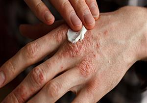 كيف يؤثر التهاب الجلد التأتبي على الصحة العقلية والنفسية؟
