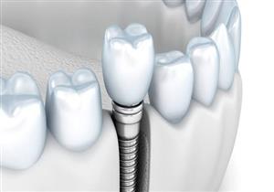 أحمد ماهر: 7 خطوات صحيحة يجب اتباعها لزراعة الأسنان 
