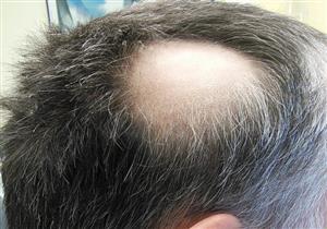 علماء يكشفون العلاقة بين تساقط الشعر وأمراض المناعة