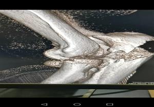 فريق طبي بمستشفى أبورديس ينقذ ذراع مصاب في حادث سير