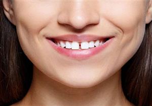 فراغات الأسنان- هل نقص الكالسيوم سببها الرئيسي؟