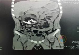 ظل يحمله 7 سنوات.. استئصال جنين من بطن شقيقه في الإسكندرية- صور