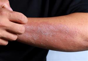 أمراض جلدية شائعة في الصيف- دليلك للوقاية