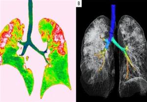 إليك ما يحدث لرئة المصاب بفيروس كورونا 