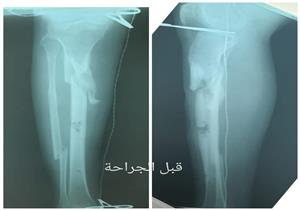 بالصور.. نجاح جراحة دقيقة لمريض مصاب بالشلل في مستشفى أبو سمبل الدولي