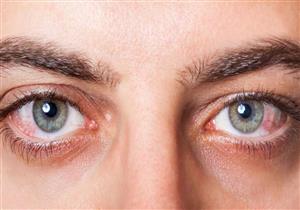 متى يتطلب علاج جفاف العين إجراء جراحة؟