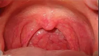 أصوات وإنذارات من جسدك.. إشارات مبكرة قد تدل على سرطان الحلق