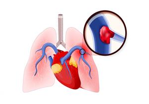 8 أعراض تكشف إصابتك بالجلطة الرئوية.. إليك أسبابها وطرق علاجها
