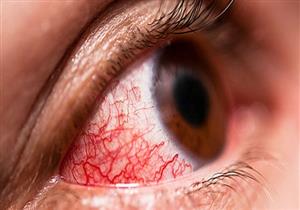 3 أنواع لالتهاب ملتحمة العين.. كيف تفرق بينهم؟