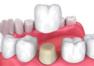 فوائد مذهلة لتغليف الأسنان.. متى ينصح الأطباء به؟