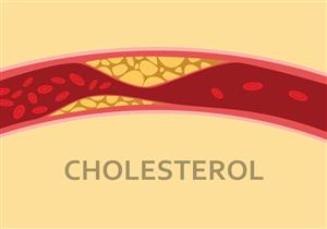 هل يسبب الكوليسترول الدوخة؟