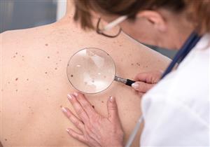 أخطر أنواع سرطتان الجلد- علامات تكشف إصابتك بالميلانوما