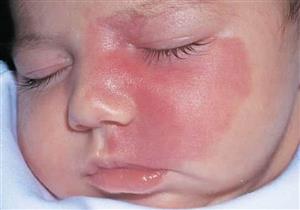 سر ظهور الوحمة لدى الطفل وطرق العلاج.. هل "توحم الأم" له علاقة؟