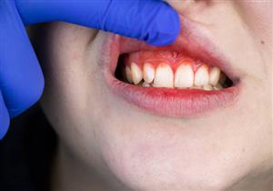 التهاب اللثة.. متى يستدعي زيارة طبيب الأسنان؟