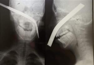خرج من عينه.. استخراج سيخ حديد من وجه طفل بالمنيا