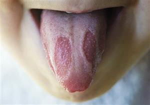 هل تشير بقع اللسان إلى الإصابة بسرطان الفم؟