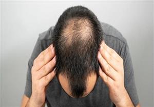 أشياء هامة عليك معرفتها قبل الإقدام على زراعة الشعر