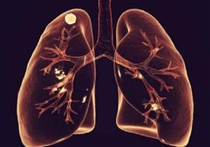 6 علامات "مفاجئة" لسرطان مميت قد لا يعرفها الجميع
