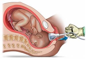 شفط رأس الجنين أثناء الولادة.. 5 مخاطر قد يسببها للأم والرضيع