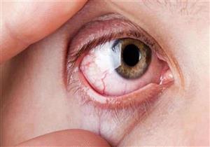 علاج جفاف العيون في المنزل– هل يحقق نتائج فعالة؟