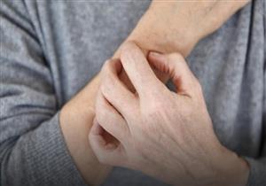 6 نصائح للتخلص من حكة الجلد في الشتاء