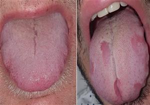 "طبقة من الفرو".. علامة على اللسان تؤكد الإصابة بكورونا