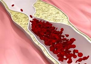اكتشاف خطر جديد لارتفاع مستوى الكوليسترول في الدم