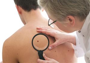 طبيبة تحذر الرجال: هذه العلامة قد تدل على الإصابة بسرطان الجلد