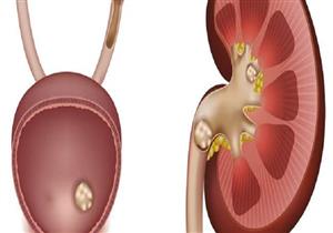 طبيب يكشف المواد الغذائية المسببة لتكون حصى الكلى