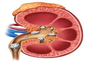 شرطان لعلاج حصوات الكلى دون عملية جراحية.. اعرفهما