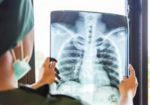 الأشعة السينية تكشف عن آثار تلف الرئة لدى مرضى كورونا غير الملقحين