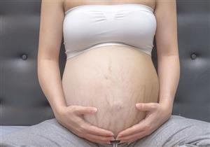 لماذا تظهر تشققات البطن أثناء الحمل؟.. هكذا تتخلصين منها