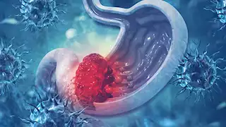 احذر.. 5 علامات تكشف الإصابة بـ سرطان المعدة