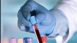 اختبار دم يتنبأ بعودة سرطان الثدي