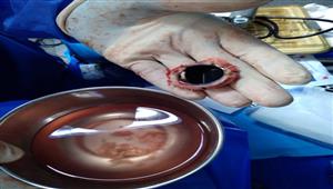 تفاصيل إنقاذ طفلة وسيدة تعانيان من مشاكل في صمامات القلب بمستشفى بنها الجامعي